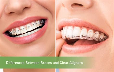 clear braces leatherhead|The Difference Between Clear Braces and Clear Aligners .